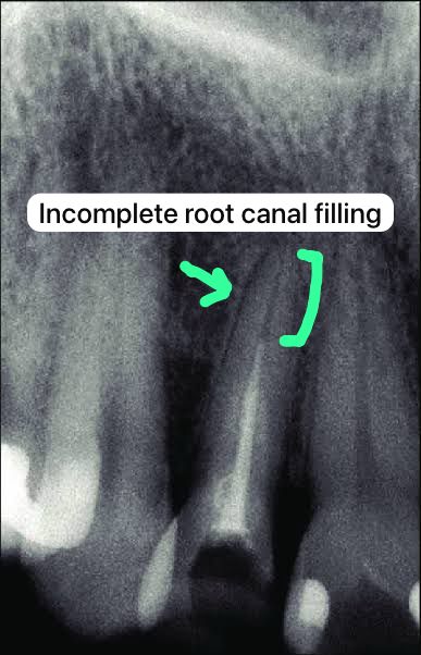 Successful Implant